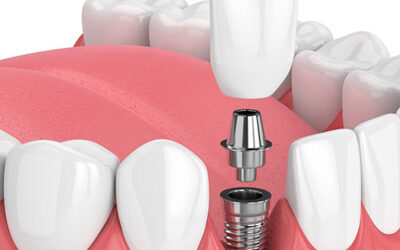 cosmodentalcare in Kondapur - Dental Implants